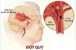 Các dấu hiệu đột quỵ, bạn phải gọi cấp cứu 115 ngay