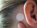 Một số thuốc chống nôn dạng cao dán có tác dụng tại chỗ.