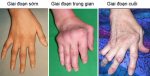 Các giai đoạn của bệnh viêm khớp dạng thấp. Ảnh: CTN.