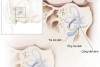 Quan điểm về Cống tiền đình giãn rộng