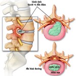 Thoát vị đĩa đệm hệ quả của các thói quen sai