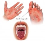 Cảnh báo bệnh tay chân miệng lan rộng