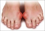 Chế độ ăn phòng ngừa bệnh gút
