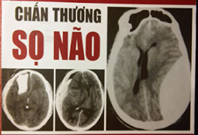 Chấn thương sọ não