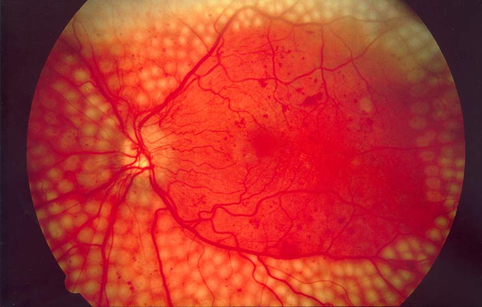 Phẫu thuật laser quang đông VM vẫn là lựa chọn đầu tay để điều trị phù hoàng điểm do ĐTĐ không liên quan tới vùng trung tâm. Ảnh: Wikipedia