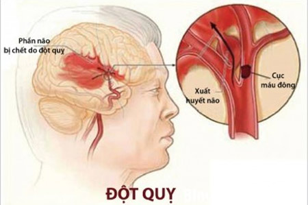 Các dấu hiệu đột quỵ, bạn phải gọi cấp cứu 115 ngay
