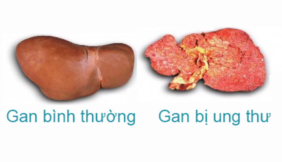 Xét nghiệm phát hiện sớm ung thư gan