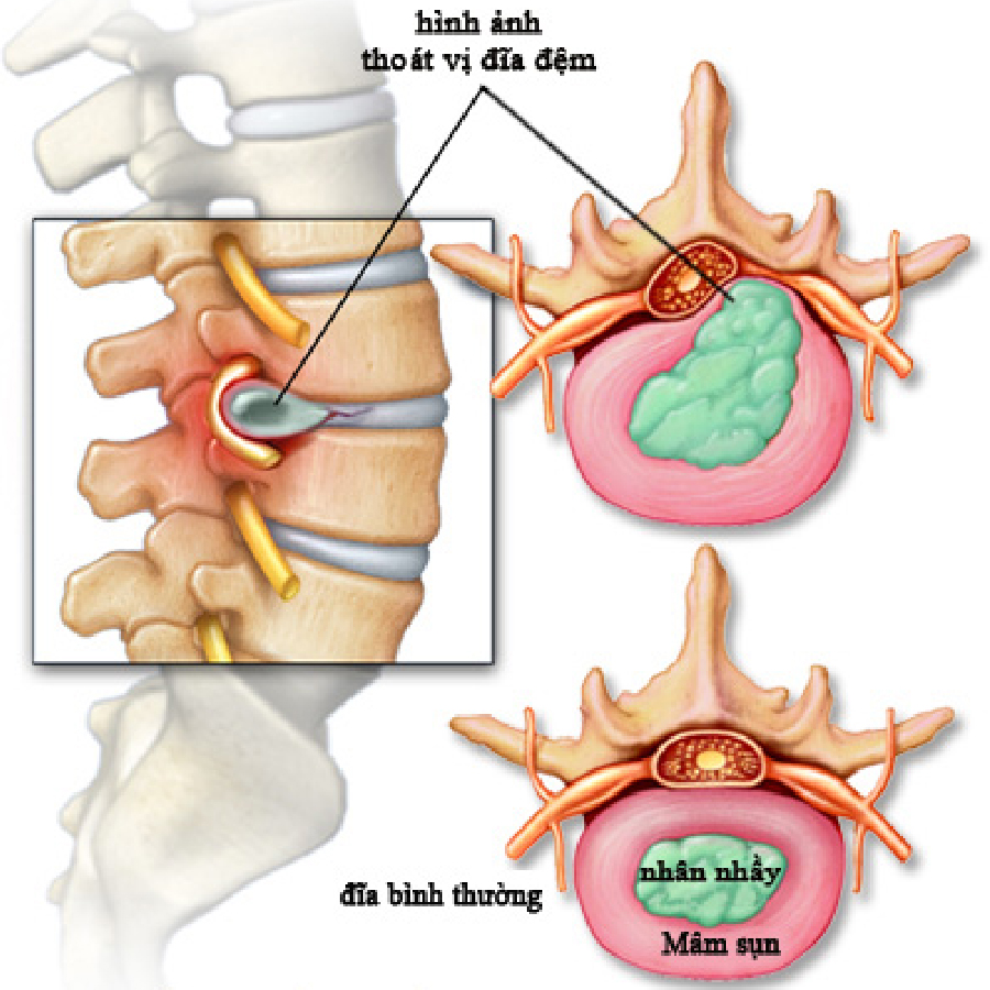 Thoát vị đĩa đệm hệ quả của các thói quen sai