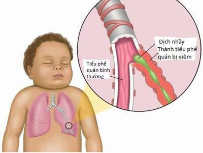 Mùa lạnh phòng bệnh viêm đường hô hấp cho trẻ