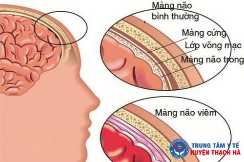 Hình ảnh viêm màng não.
